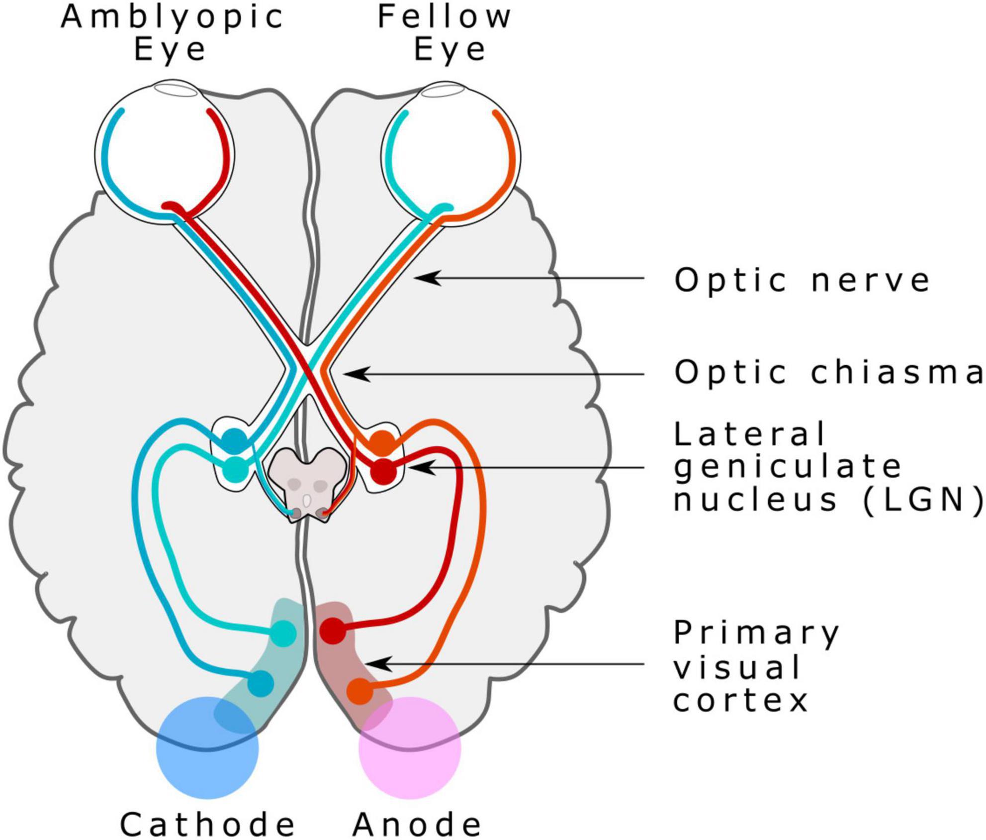 Combined therapy of bilateral transcranial direct current stimulation and ocular occlusion improves visual function in adults with amblyopia, a randomized pilot study